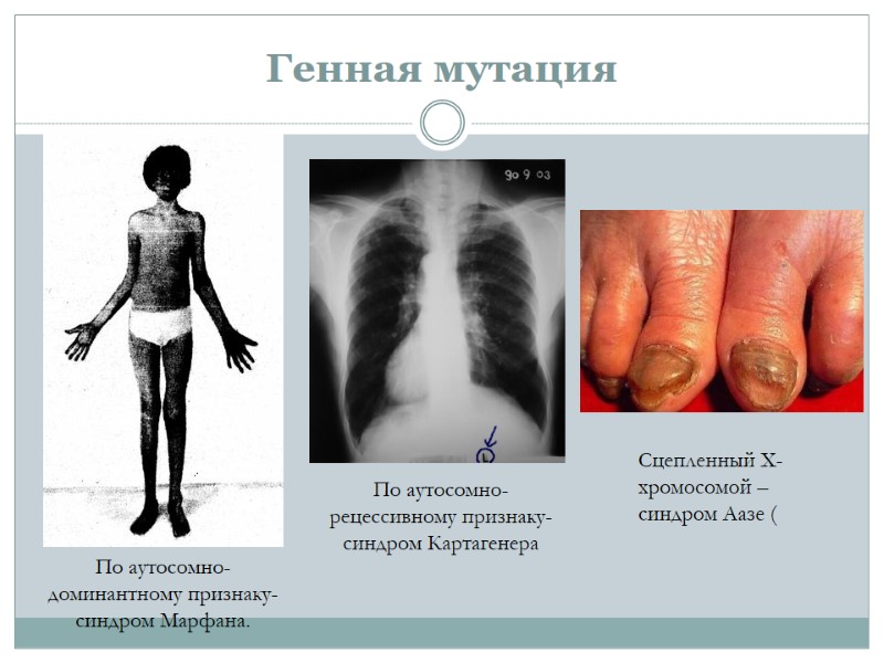 Генная мутация По аутосомно-доминантному признаку-синдром Марфана. По аутосомно-рецессивному признаку- синдром Картагенера Сцепленный Х-хромосомой –